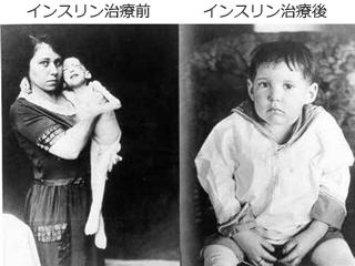 インスリンの発見